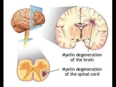 Scleroza multipla - mecanisme neuroimunologice